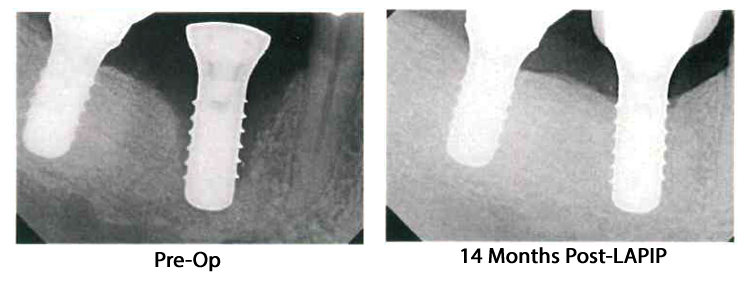 LimbSal Ortho 3D Printed Customized Implant by AM Incredible, Made in India